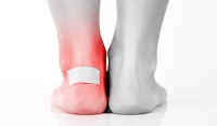 What to Do if You Have a Foot Blister