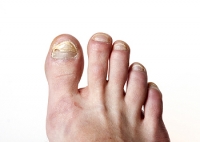 How to Deal With Toenail Fungus