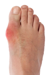 Symptoms and Causes of Gout