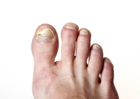 Fungal Infection and Other Causes of Thickened Toenails