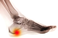 Definition and Symptoms of Heel Spurs
