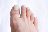 Reducing the Symptoms of Gout