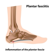 Painful Plantar Fasciitis
