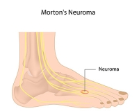 What Can Cause Burning Pain in the Ball of Your Foot?