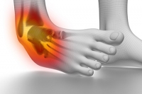 What to Do After You Sprain an Ankle